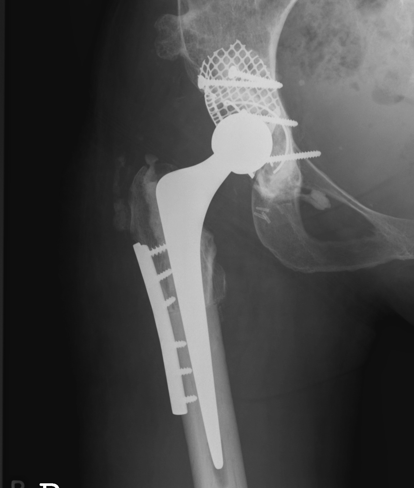 THR DDH Subtrochanteric Osteotomy